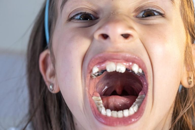 Dientes calcáreos: cómo los padres pueden prevenir los defectos del esmalte en los niños