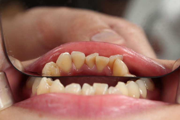Tipos de maloclusión dental
